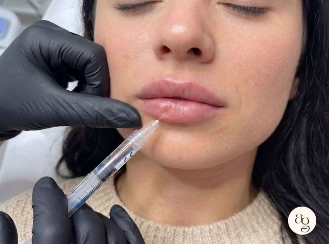 Tratamiento de ácido hialurónico en Coacalco realizado por doctora certificada en Afterglow