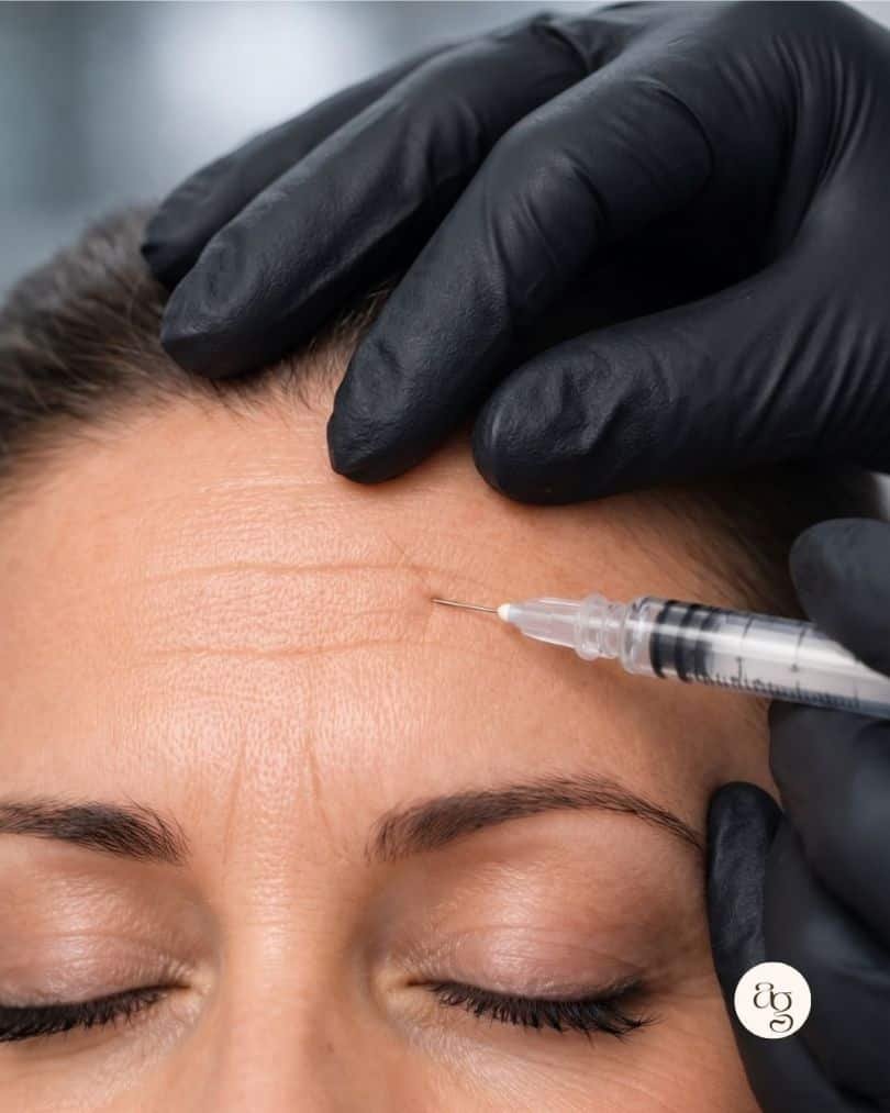 Zonas de aplicación de botox en frente, entrecejo y patas de gallo