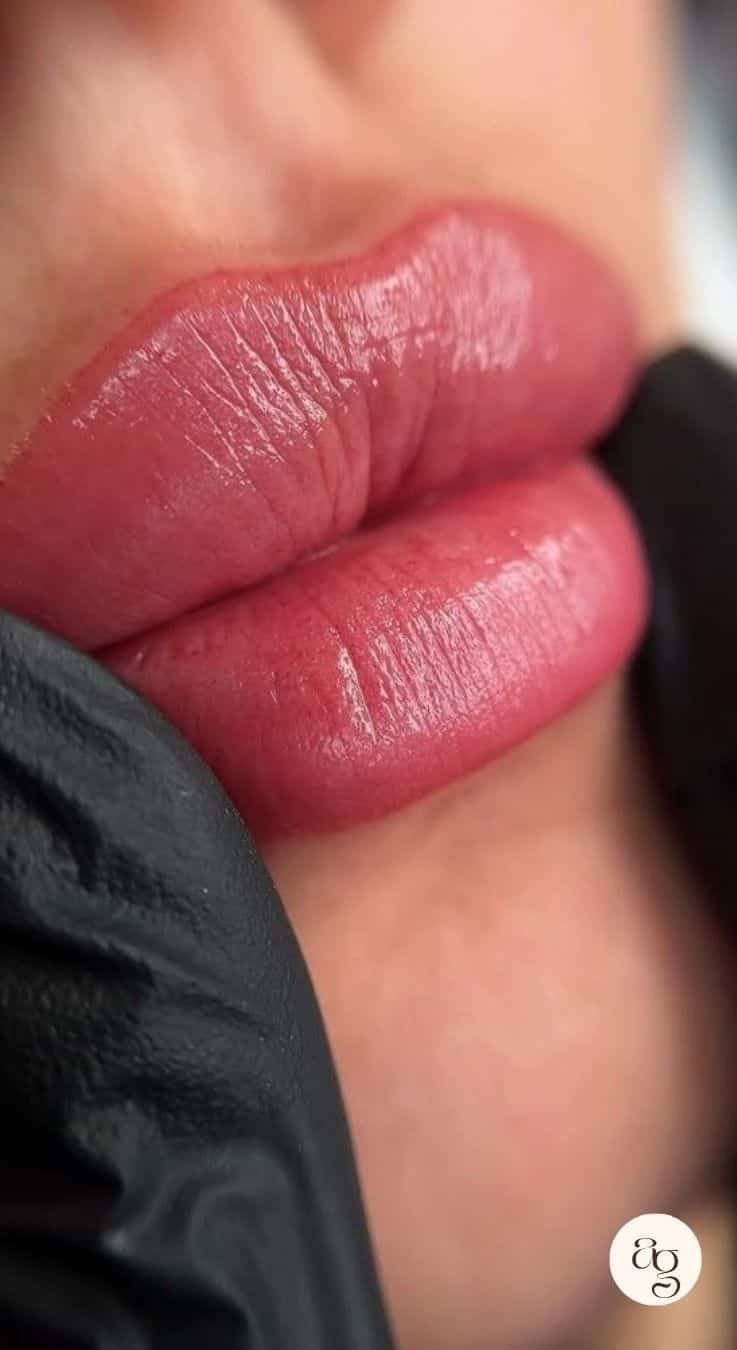 Relleno y perfilado de labios con ácido hialurónico en Coacalco