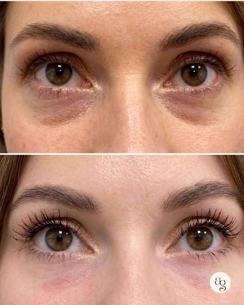 Tratamiento para ojeras y rejuvenecimiento de la mirada en Coacalco - Afterglow